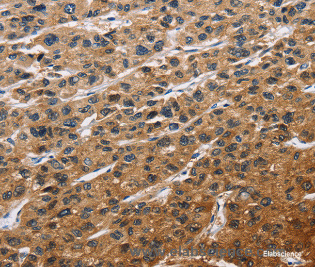 Immunohistochemistry of paraffin-embedded Human liver cancer tissue using EIF4EBP2 Polyclonal Antibody at dilution 1:40