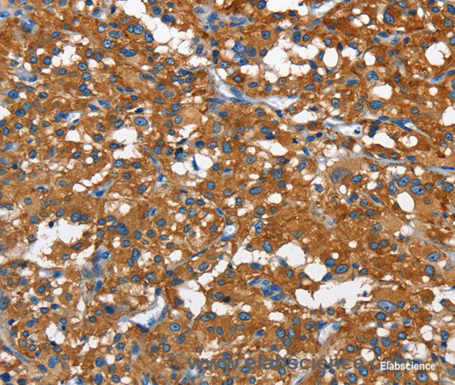 Immunohistochemistry of paraffin-embedded Human thyroid cancer tissue using CAMK1D Polyclonal Antibody at dilution 1:50