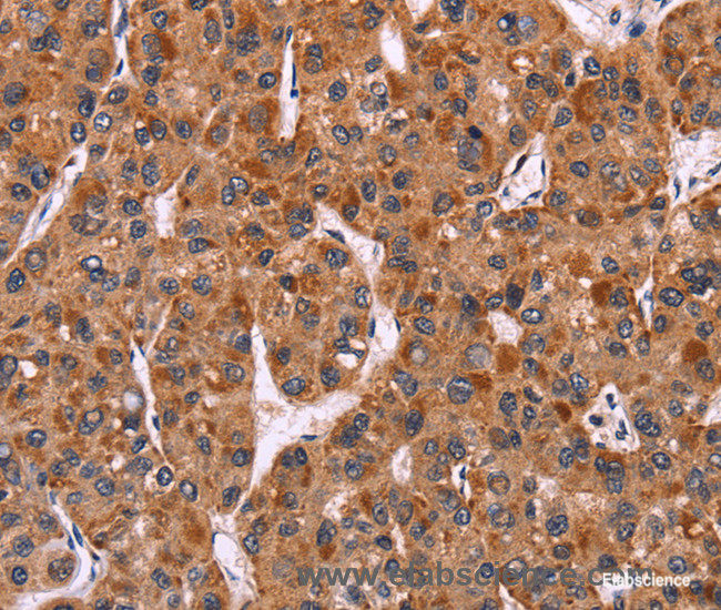 Immunohistochemistry of paraffin-embedded Human liver cancer tissue using CARD11 Polyclonal Antibody at dilution 1:40