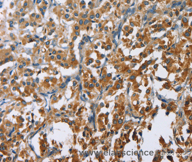 Immunohistochemistry of paraffin-embedded Human thyroid cancer tissue using CARD9 Polyclonal Antibody at dilution 1:60