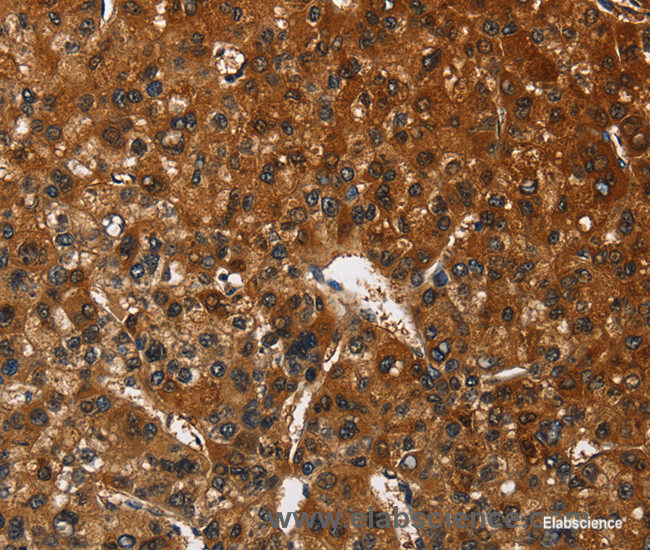 Immunohistochemistry of paraffin-embedded Human liver cancer tissue using CATSPER4 Polyclonal Antibody at dilution 1:50