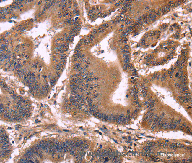 Immunohistochemistry of paraffin-embedded Human colon cancer tissue using CCDC106 Polyclonal Antibody at dilution 1:50