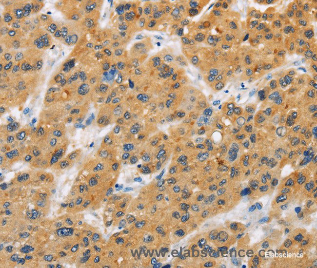 Immunohistochemistry of paraffin-embedded Human liver cancer tissue using CD272 Polyclonal Antibody at dilution 1:30