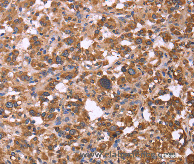 Immunohistochemistry of paraffin-embedded Human thyroid cancer tissue using FBXW7 Polyclonal Antibody at dilution 1:30