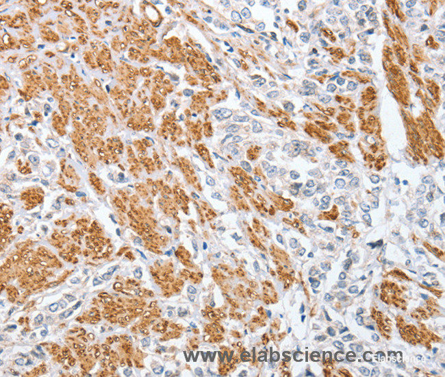 Immunohistochemistry of paraffin-embedded Human prostate cancer tissue using CENPC Polyclonal Antibody at dilution 1:70