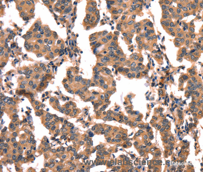 Immunohistochemistry of paraffin-embedded Human breast cancer tissue using hCG Polyclonal Antibody at dilution 1:65