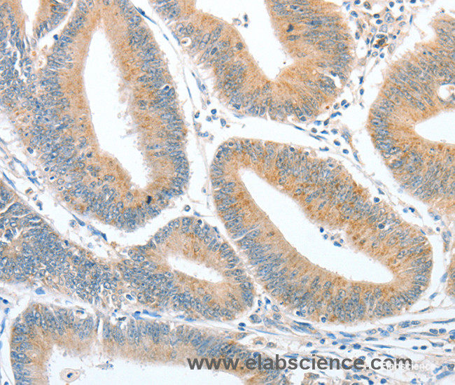 Immunohistochemistry of paraffin-embedded Human colon cancer tissue using CKAP2 Polyclonal Antibody at dilution 1:50