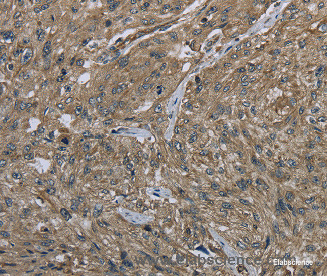 Immunohistochemistry of paraffin-embedded Human esophagus cancer tissue using CLPS Polyclonal Antibody at dilution 1:40