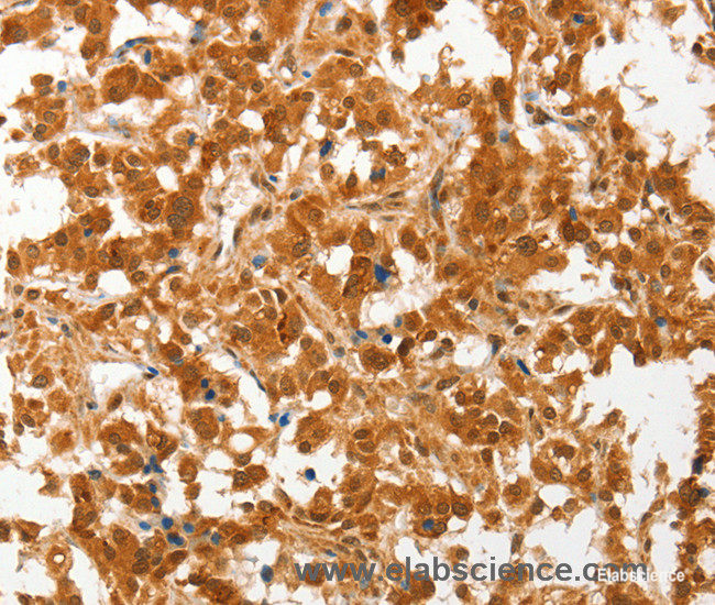 Immunohistochemistry of paraffin-embedded Human thyroid cancer tissue using COL4A3BP Polyclonal Antibody at dilution 1:50