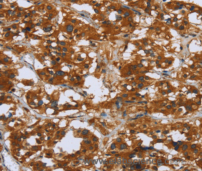 Immunohistochemistry of paraffin-embedded Human thyroid cancer tissue using COMP Polyclonal Antibody at dilution 1:50