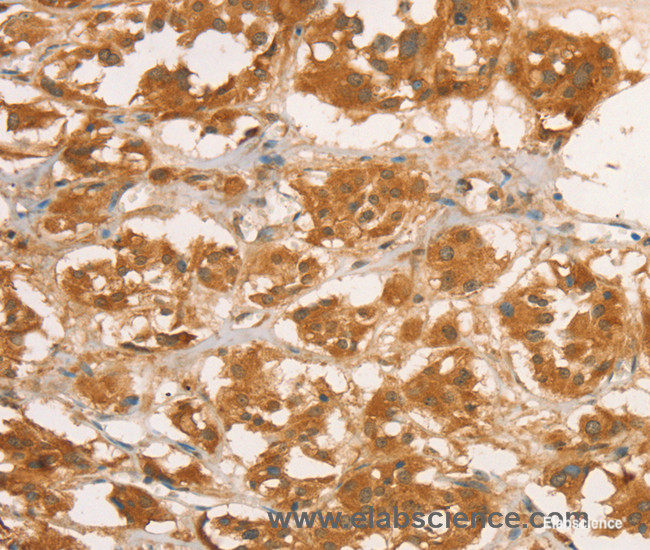 Immunohistochemistry of paraffin-embedded Human thyroid cancer tissue using CPB1 Polyclonal Antibody at dilution of 1:50
