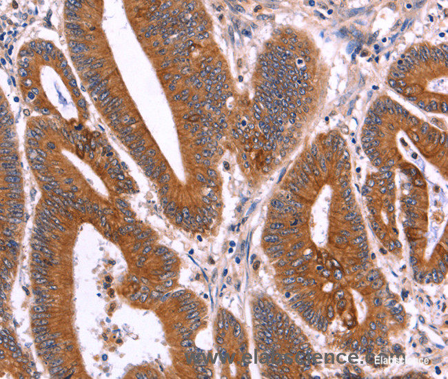 Immunohistochemistry of paraffin-embedded Human colon cancer tissue using CRISP3 Polyclonal Antibody at dilution 1:40