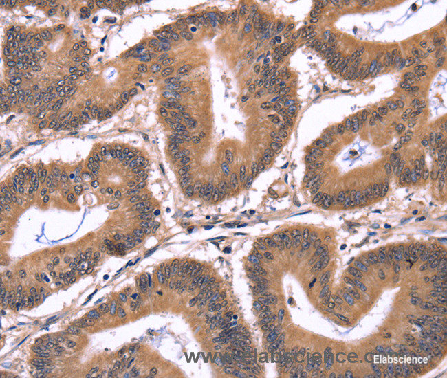 Immunohistochemistry of paraffin-embedded Human colon cancer tissue using CRK Polyclonal Antibody at dilution 1:50