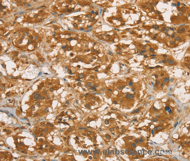 Immunohistochemistry of paraffin-embedded Human thyroid cancer tissue using RBBP8 Polyclonal Antibody at dilution 1:45