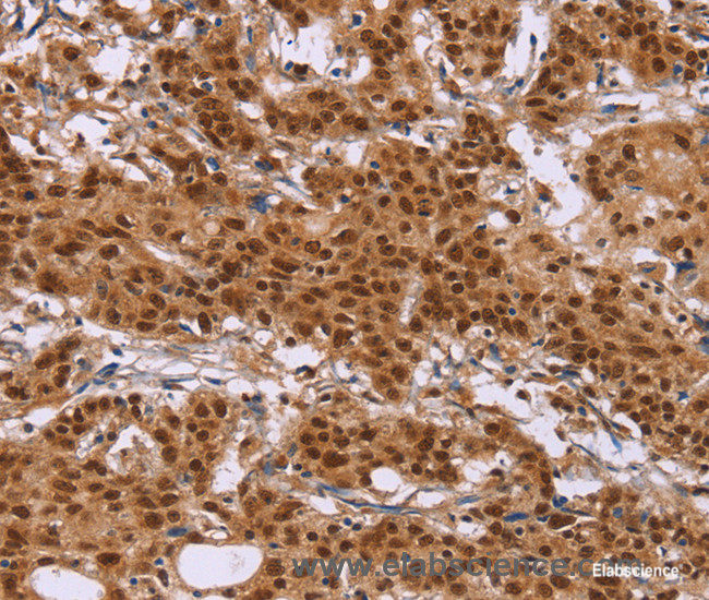 Immunohistochemistry of paraffin-embedded Human gastric cancer tissue using CTNNBL1 Polyclonal Antibody at dilution 1:50