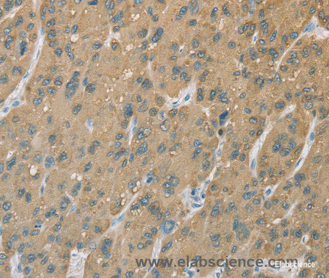Immunohistochemistry of paraffin-embedded Human liver cancer tissue using CYP2C9 Polyclonal Antibody at dilution 1:50