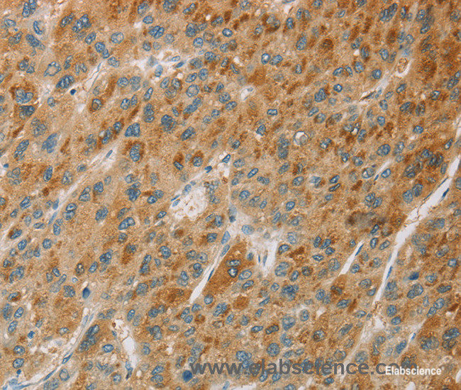 Immunohistochemistry of paraffin-embedded Human liver cancer tissue using CYP11B1 Polyclonal Antibody at dilution 1:30