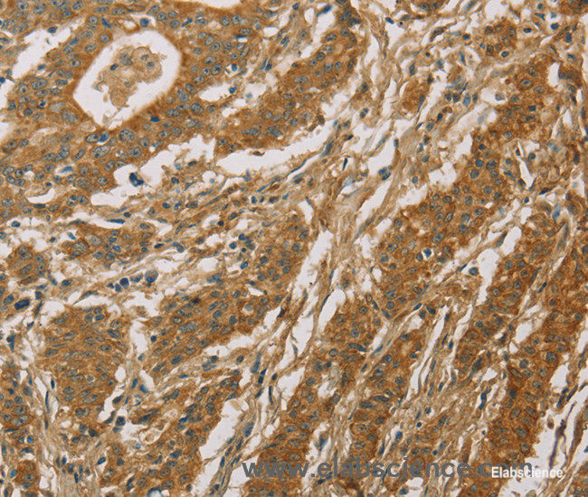 Immunohistochemistry of paraffin-embedded Human gasrtic cancer tissue using CYP39A1 Polyclonal Antibody at dilution 1:50