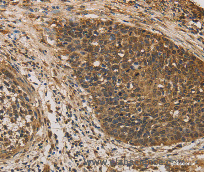 Immunohistochemistry of paraffin-embedded Human cervical cancer tissue using DACH1 Polyclonal Antibody at dilution 1:50