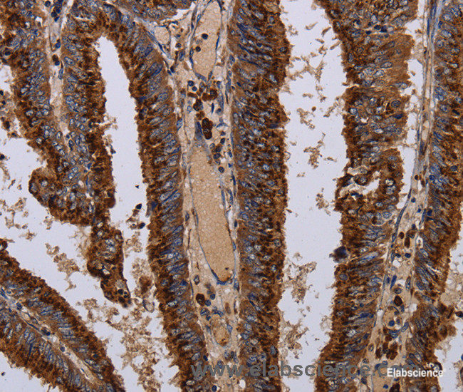 Immunohistochemistry of paraffin-embedded Human colon cancer tissue using PPP1R1B Polyclonal Antibody at dilution 1:50
