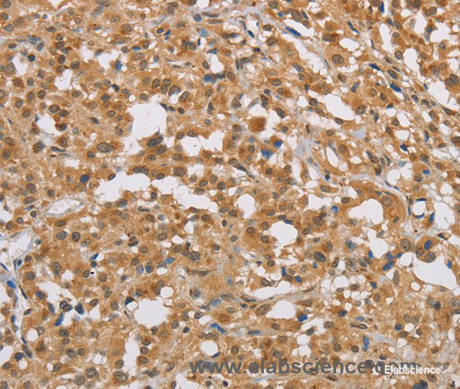 Immunohistochemistry of paraffin-embedded Human thyroid cancer tissue using DIO1 Polyclonal Antibody at dilution 1:50