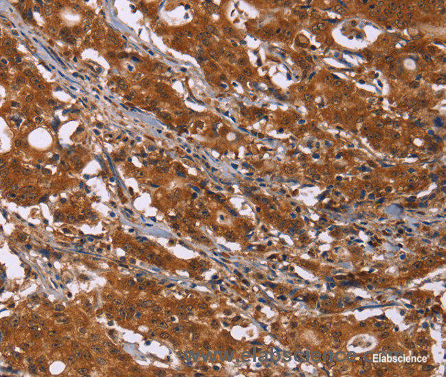 Immunohistochemistry of paraffin-embedded Human gasrtic cancer tissue using DCBLD2 Polyclonal Antibody at dilution 1:50