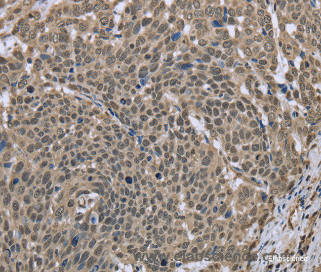 Immunohistochemistry of paraffin-embedded Human cervical cancer tissue using DCTN4 Polyclonal Antibody at dilution 1:30