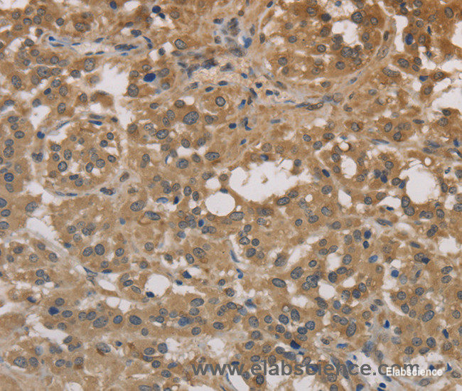 Immunohistochemistry of paraffin-embedded Human thyroid cancer tissue using DEGS1 Polyclonal Antibody at dilution 1:30