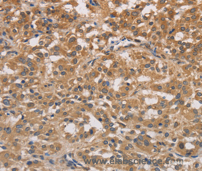 Immunohistochemistry of paraffin-embedded Human thyroid cancer tissue using DSTN Polyclonal Antibody at dilution 1:30