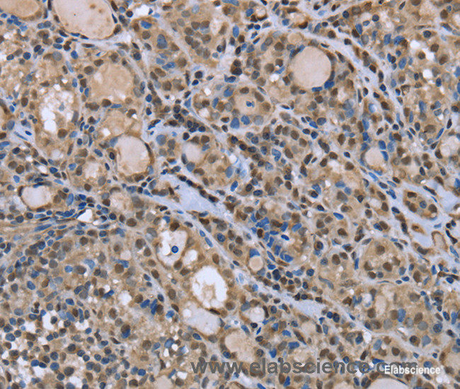 Immunohistochemistry of paraffin-embedded Human thyroid cancer tissue using DYNLL1 Polyclonal Antibody at dilution 1:30