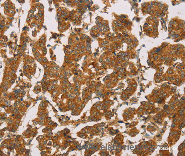 Immunohistochemistry of paraffin-embedded Human breast cancer tissue using DLL4 Polyclonal Antibody at dilution 1:50