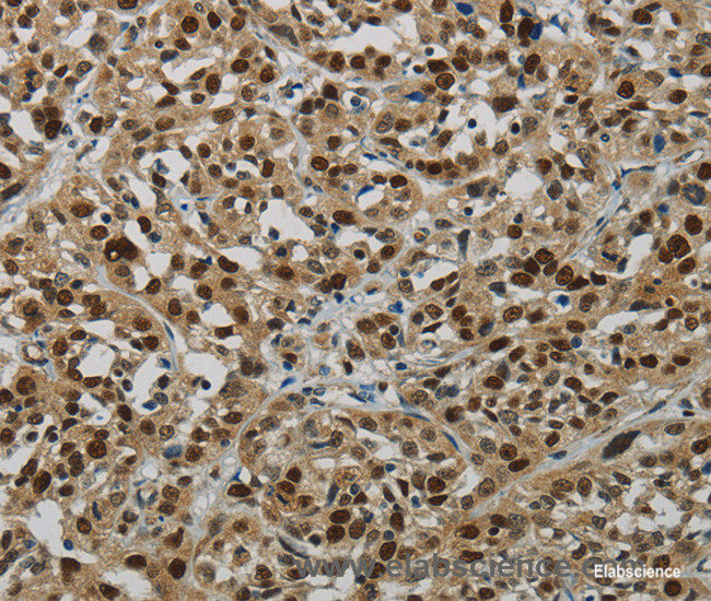 Immunohistochemistry of paraffin-embedded Human esophagus cancer tissue using DNA Ligase1 Polyclonal Antibody at dilution 1:70