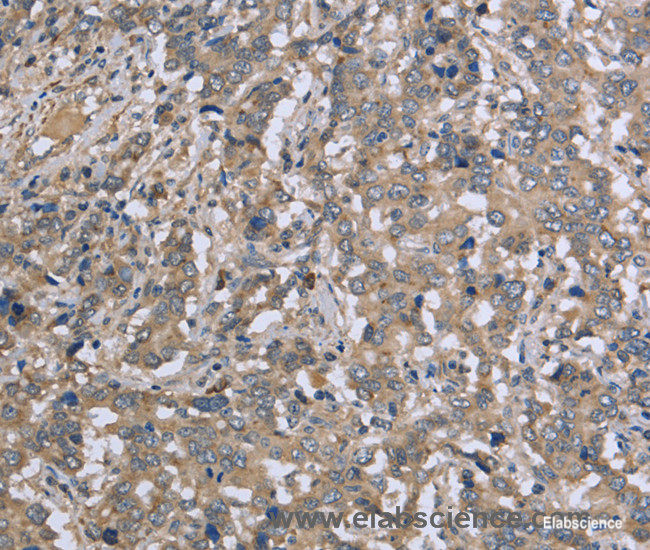 Immunohistochemistry of paraffin-embedded Human liver cancer tissue using DTNB Polyclonal Antibody at dilution 1:50