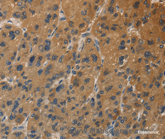 Immunohistochemistry of paraffin-embedded Human liver cancer tissue using DUSP23 Polyclonal Antibody at dilution 1:30