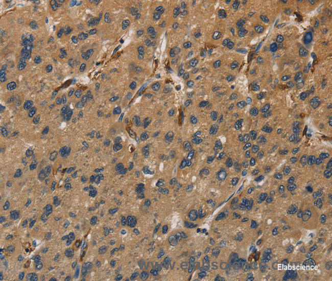 Immunohistochemistry of paraffin-embedded Human liver cancer tissue using UBE2S Polyclonal Antibody at dilution 1:40