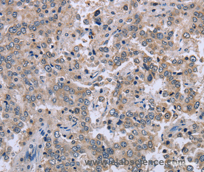 Immunohistochemistry of paraffin-embedded Human liver cancer tissue using EID1 Polyclonal Antibody at dilution 1:40