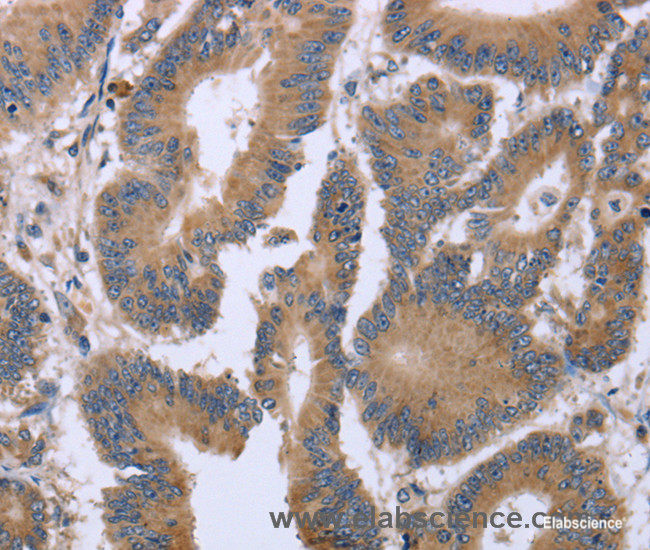 Immunohistochemistry of paraffin-embedded Human colon cancer tissue using KIAA1324 Polyclonal Antibody at dilution 1:30