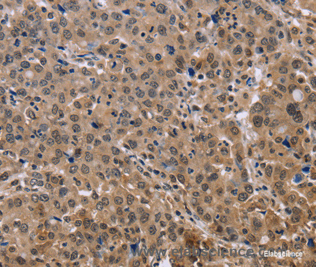 Immunohistochemistry of paraffin-embedded Human liver cancer tissue using KIF25 Polyclonal Antibody at dilution 1:40