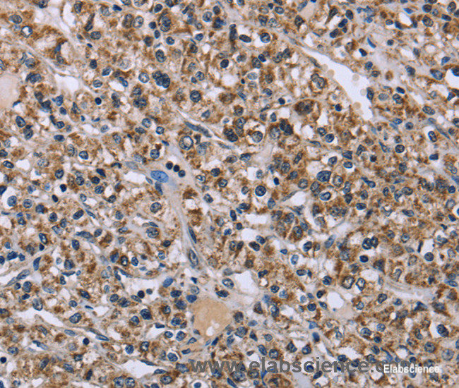 Immunohistochemistry of paraffin-embedded Human prostate cancer tissue using KCNJ11 Polyclonal Antibody at dilution 1:40