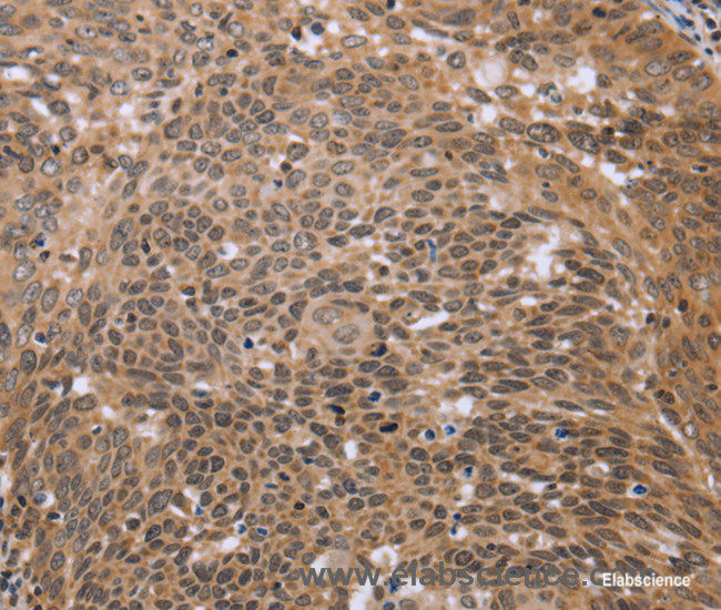 Immunohistochemistry of paraffin-embedded Human cervical cancer tissue using ERCC6L Polyclonal Antibody at dilution 1:30
