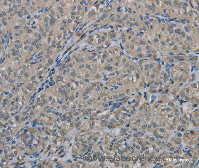 Immunohistochemistry of paraffin-embedded Human thyroid cancer tissue using EDN1 Polyclonal Antibody at dilution 1:30