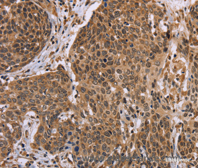 Immunohistochemistry of paraffin-embedded Human cervical cancer tissue using EDN2 Polyclonal Antibody at dilution 1:30