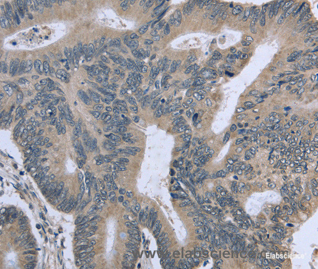 Immunohistochemistry of paraffin-embedded Human colon cancer tissue using BMX Polyclonal Antibody at dilution 1:30
