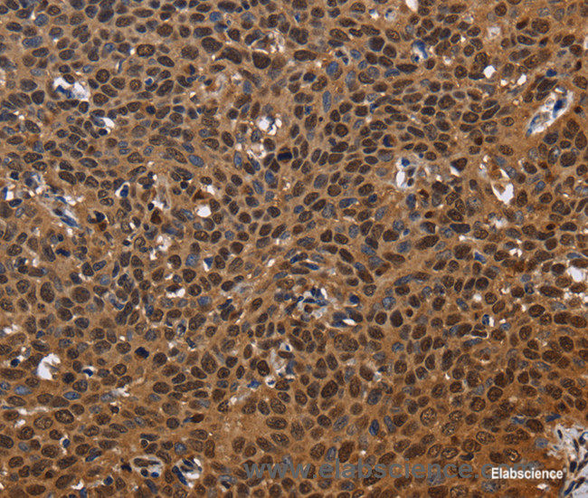 Immunohistochemistry of paraffin-embedded Human cervical cancer tissue using EXTL3 Polyclonal Antibody at dilution 1:50