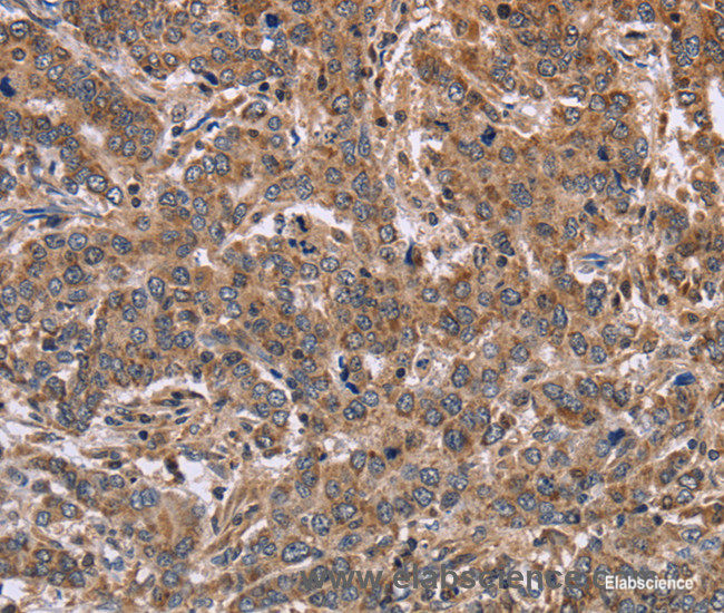 Immunohistochemistry of paraffin-embedded Human liver cancer tissue using FAAH2 Polyclonal Antibody at dilution 1:30