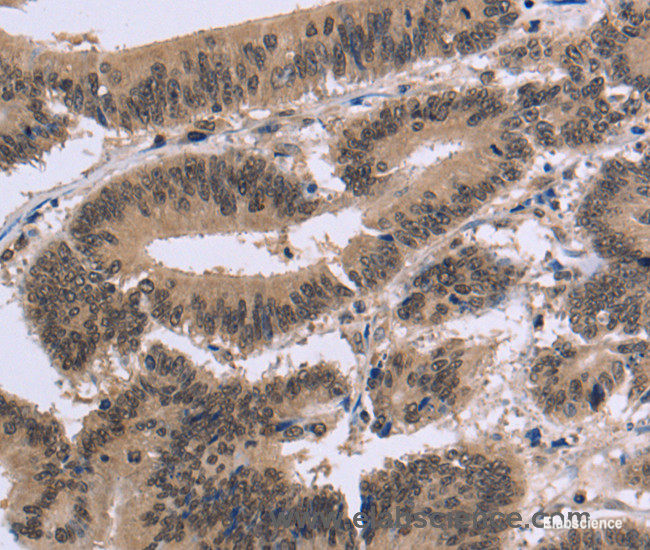 Immunohistochemistry of paraffin-embedded Human colon cancer tissue using FAM107A Polyclonal Antibody at dilution 1:30