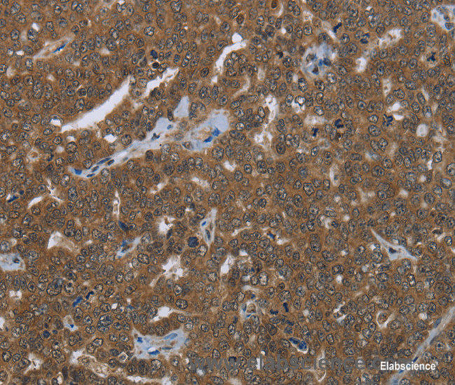 Immunohistochemistry of paraffin-embedded Human ovarian cancer tissue using FASTKD1 Polyclonal Antibody at dilution 1:50
