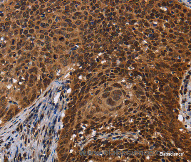 Immunohistochemistry of paraffin-embedded Human cervical cancer tissue using FASTKD5 Polyclonal Antibody at dilution 1:40