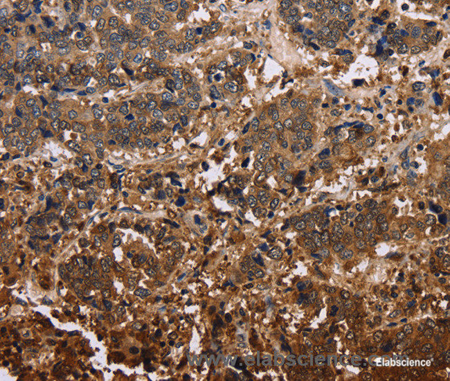 Immunohistochemistry of paraffin-embedded Human liver cancer tissue using FBP2 Polyclonal Antibody at dilution 1:40