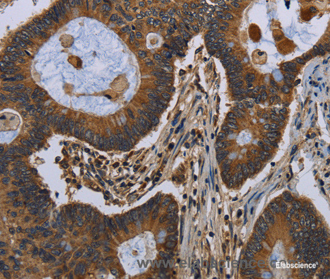 Immunohistochemistry of paraffin-embedded Human colon cancer tissue using FGF18 Polyclonal Antibody at dilution 1:40